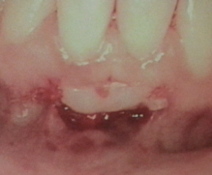 front teeth graft