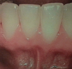 pre front teeth